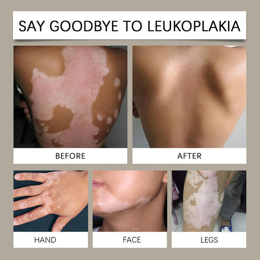 Vitigo Cream Bee Venom Treatment Cream For Skin and Rashes